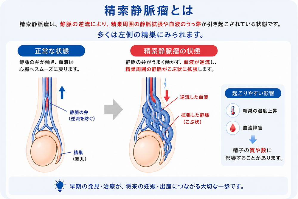精索静脈瘤手術とは